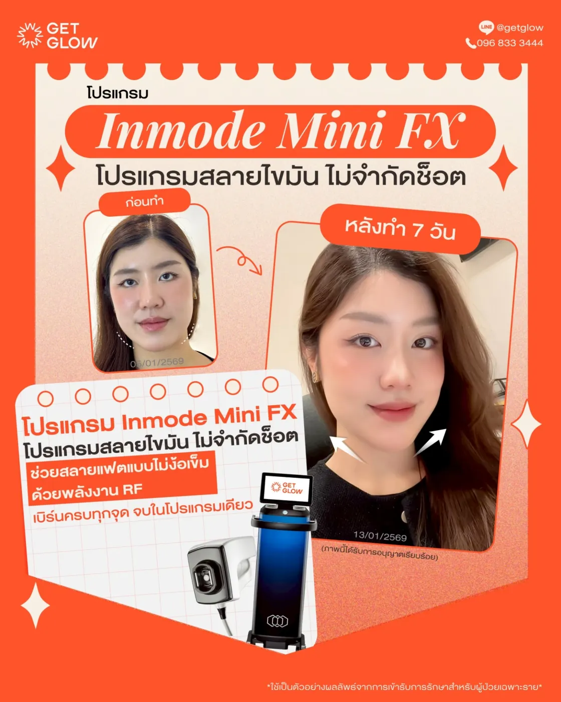 รีวิวจริง ดูแลรูปร่าง — Meso Fat (FatV) ที่ GETGLOW Clinic สยามสแควร์วัน