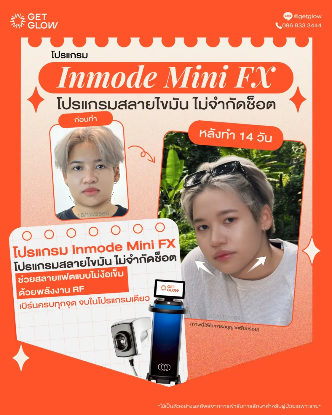 รีวิวจริง ดูแลรูปร่าง — Meso Fat (FatV) ที่ GETGLOW Clinic สยามสแควร์วัน