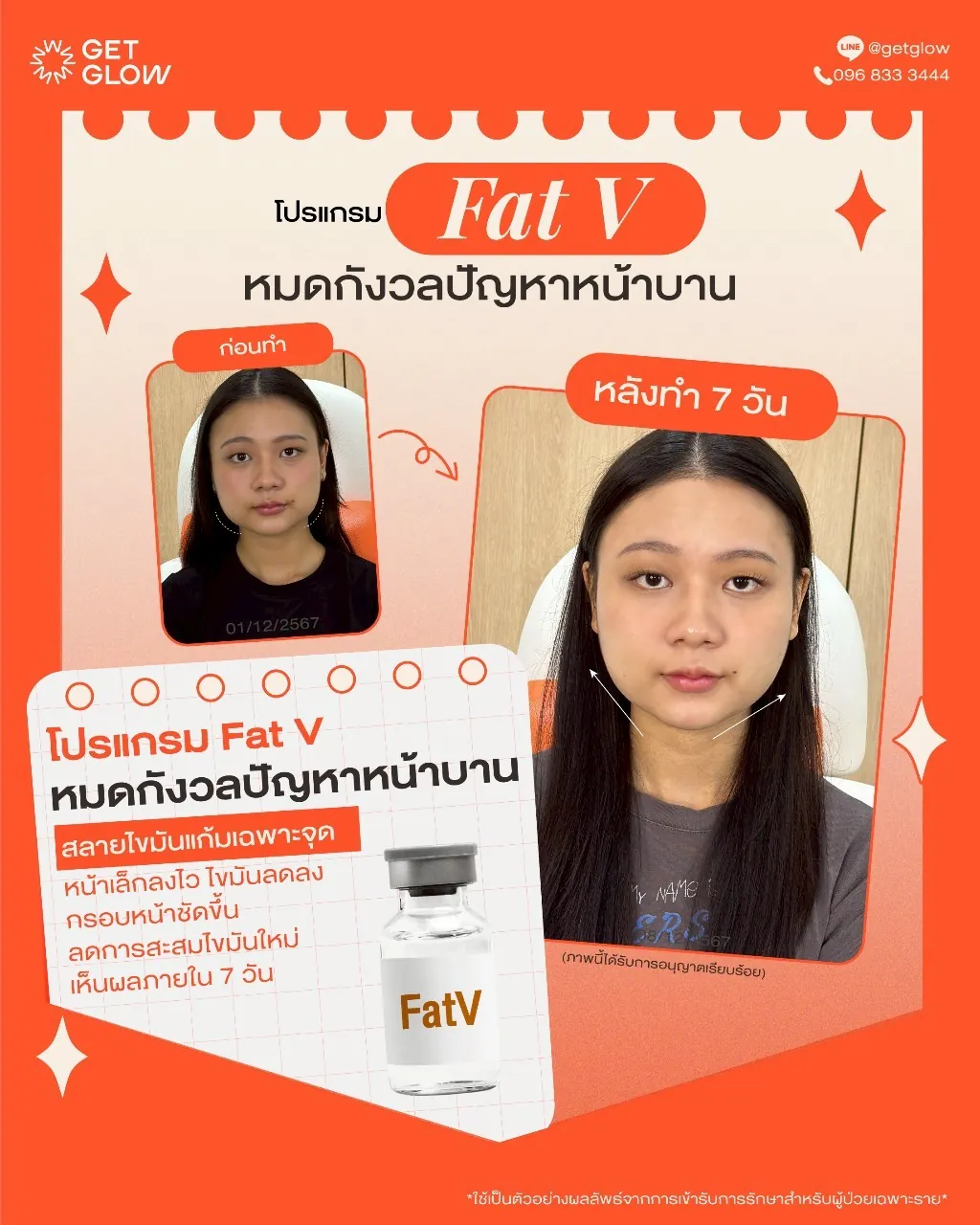 รีวิวจริง ดูแลรูปร่าง — Meso Fat (FatV) ที่ GETGLOW Clinic สยามสแควร์วัน
