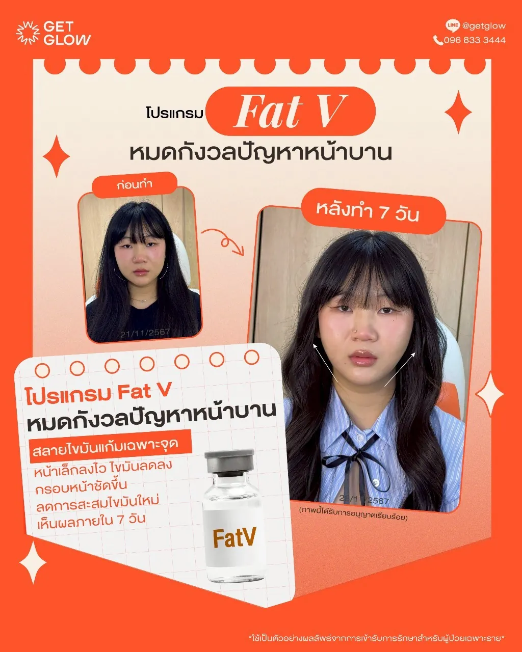 รีวิวจริง ดูแลรูปร่าง — Meso Fat (FatV) ที่ GETGLOW Clinic สยามสแควร์วัน