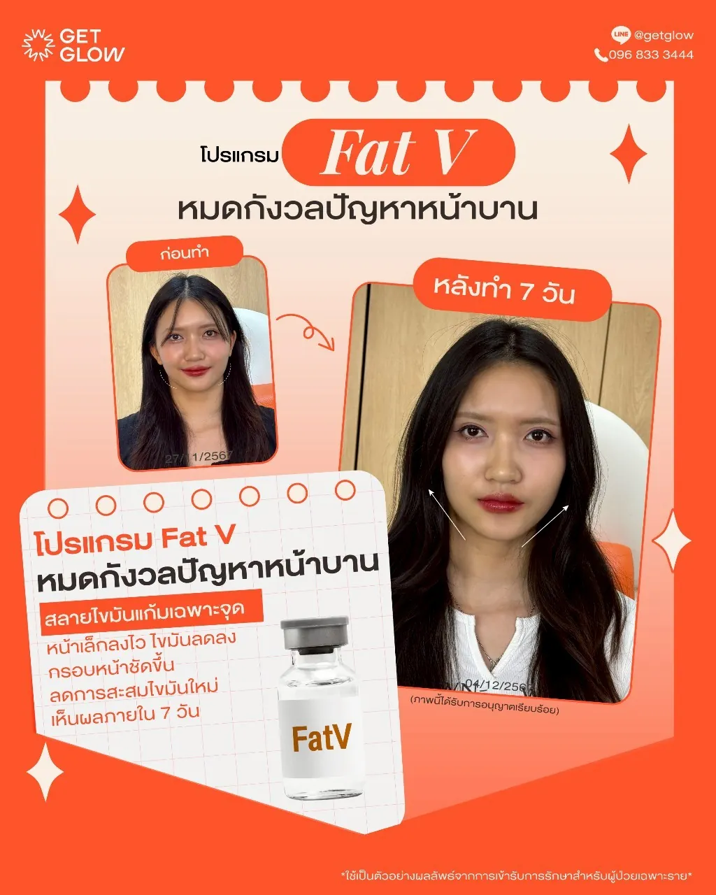 รีวิวจริง ดูแลรูปร่าง — Meso Fat (FatV) ที่ GETGLOW Clinic สยามสแควร์วัน