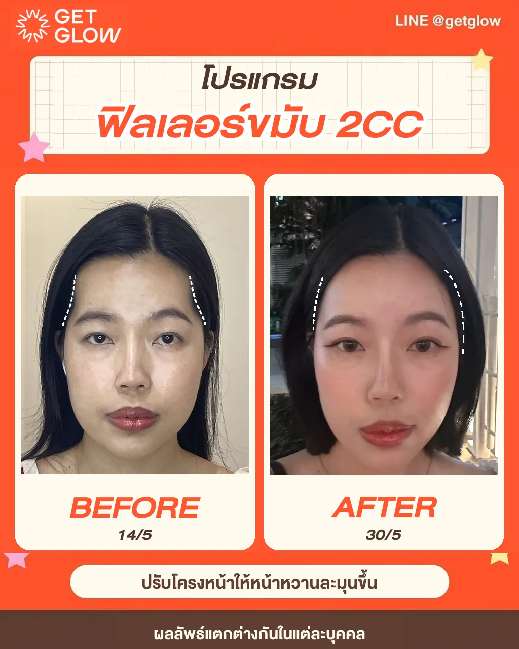 รีวิวจริง ฟิลเลอร์ — แก้ม ที่ GETGLOW Clinic สยามสแควร์วัน