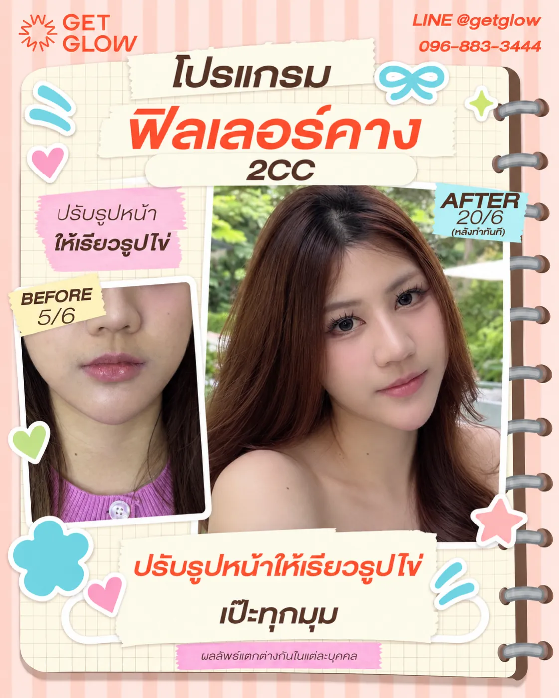 รีวิวจริง ฟิลเลอร์ — คาง ที่ GETGLOW Clinic สยามสแควร์วัน
