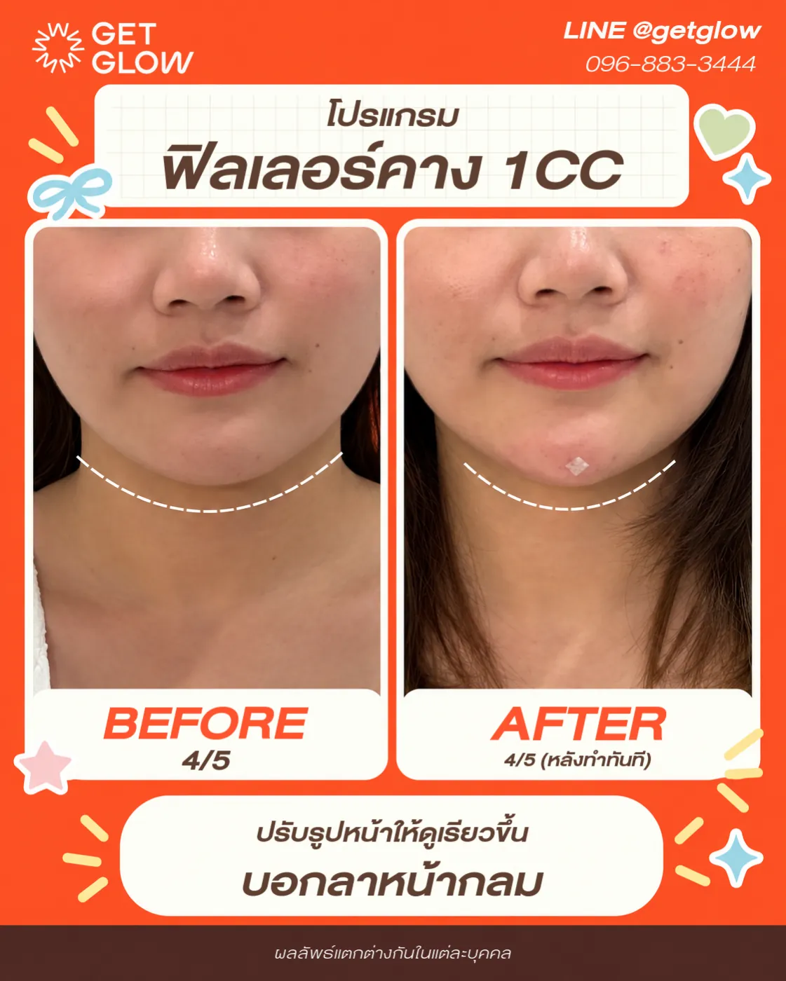 รีวิวจริง ฟิลเลอร์ — คาง ที่ GETGLOW Clinic สยามสแควร์วัน