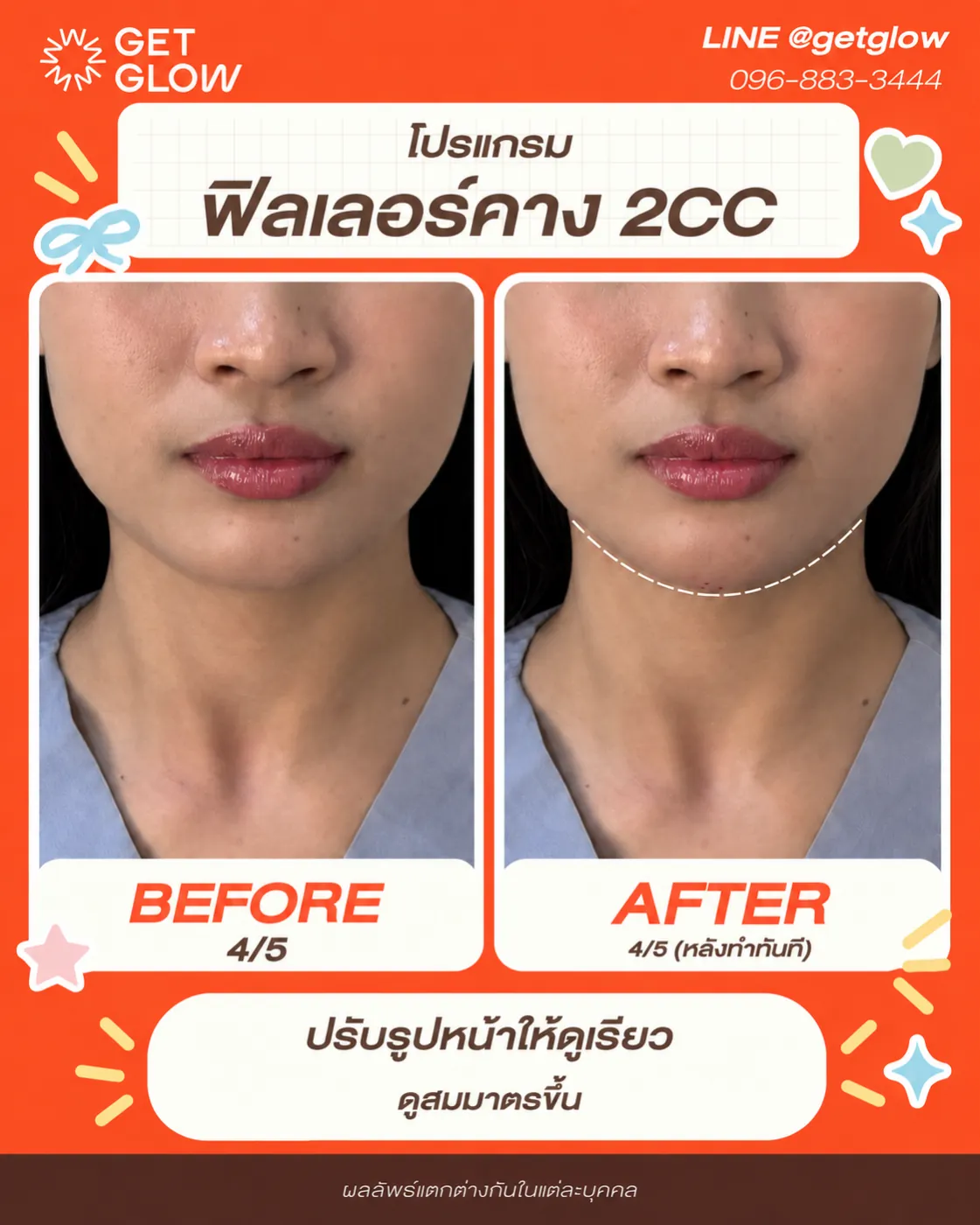 รีวิวจริง ฟิลเลอร์ — คาง ที่ GETGLOW Clinic สยามสแควร์วัน