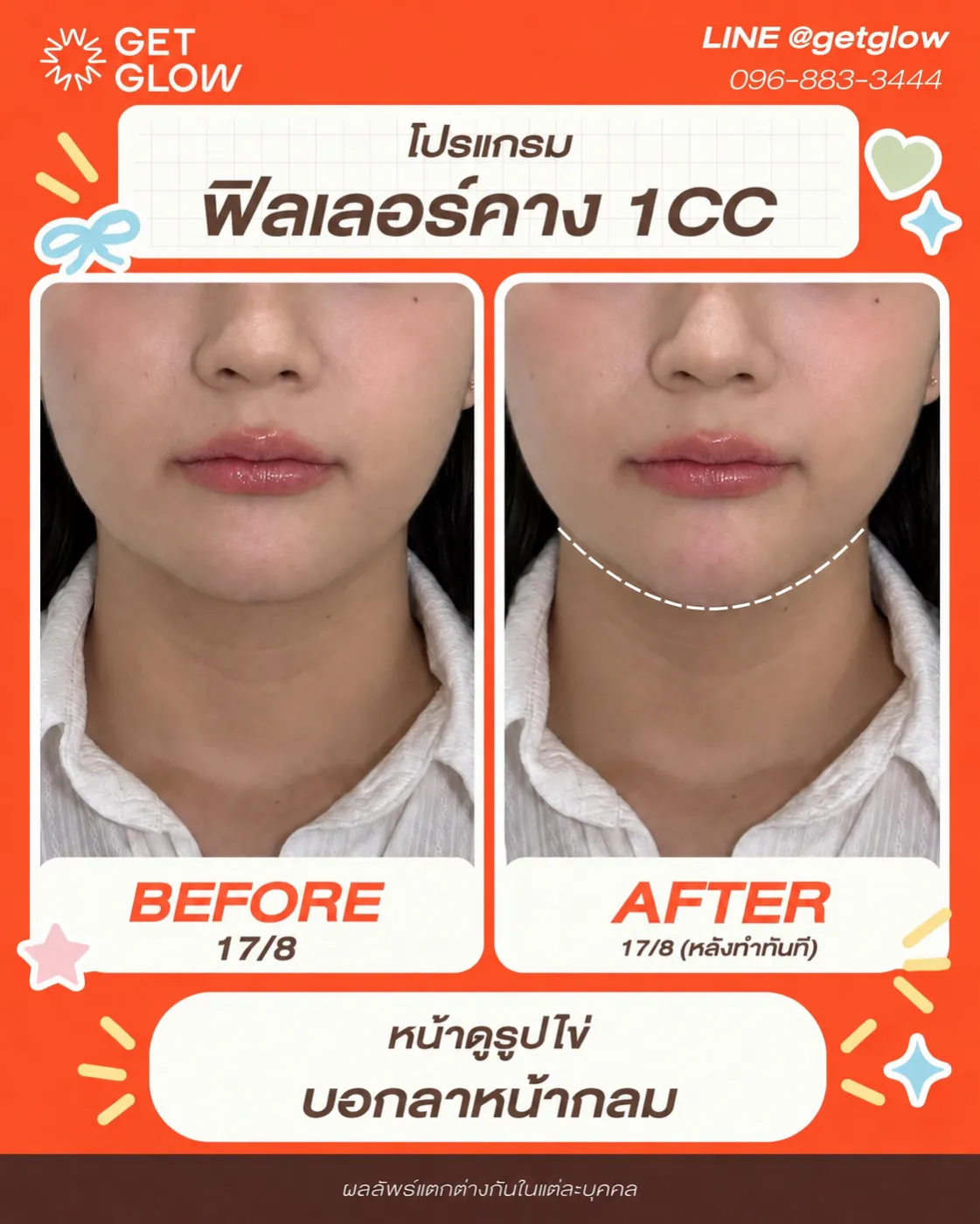 รีวิวจริง ฟิลเลอร์ — คาง ที่ GETGLOW Clinic สยามสแควร์วัน