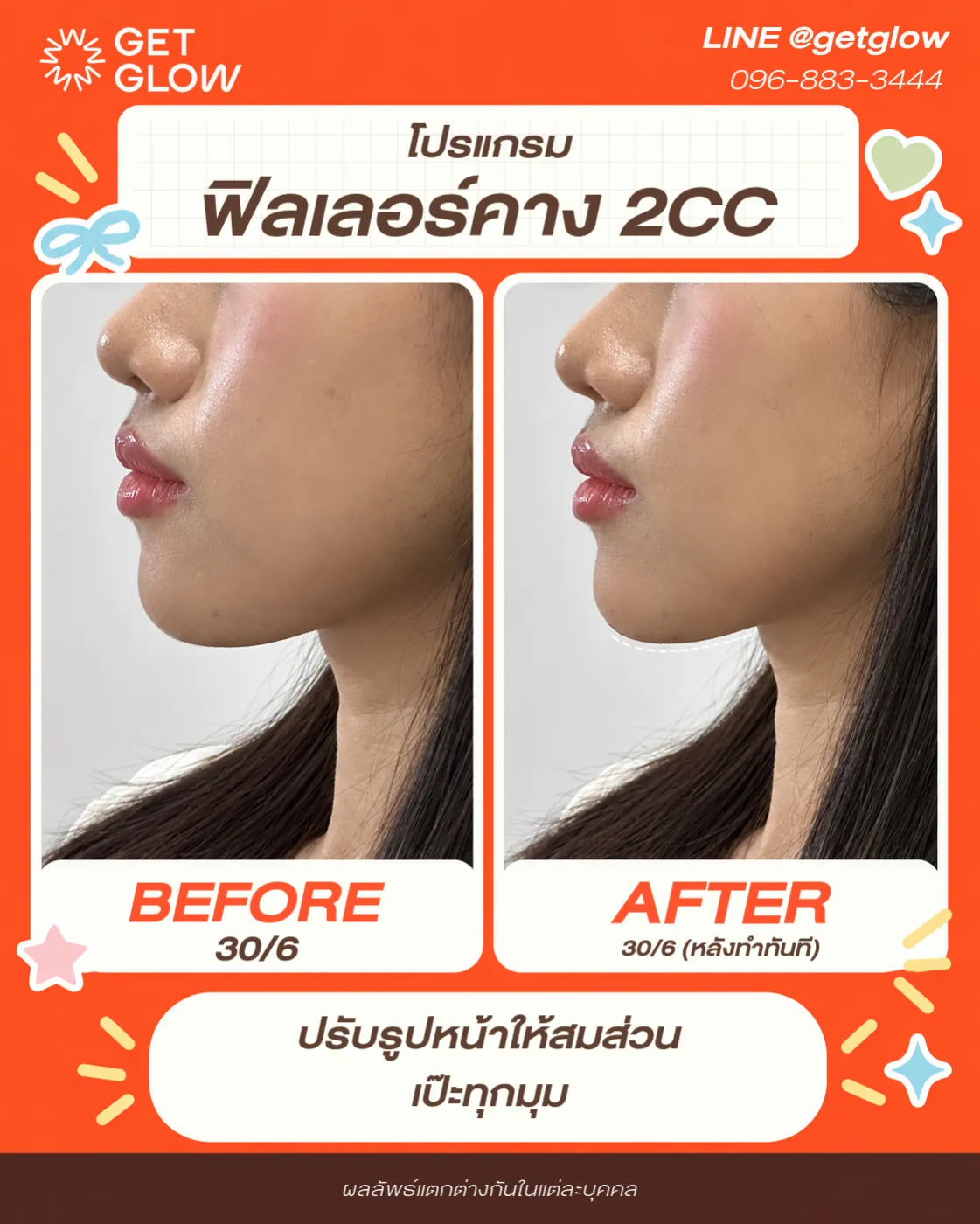 รีวิวจริง ฟิลเลอร์ — คาง ที่ GETGLOW Clinic สยามสแควร์วัน