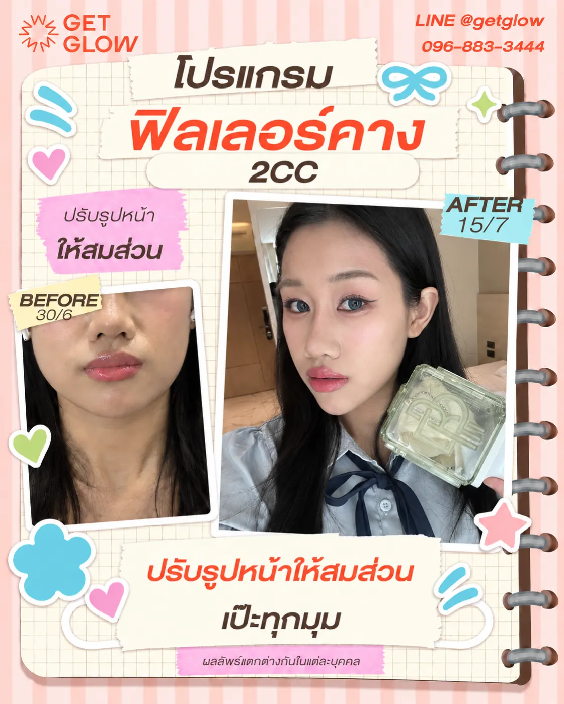 รีวิวจริง ฟิลเลอร์ — คาง ที่ GETGLOW Clinic สยามสแควร์วัน