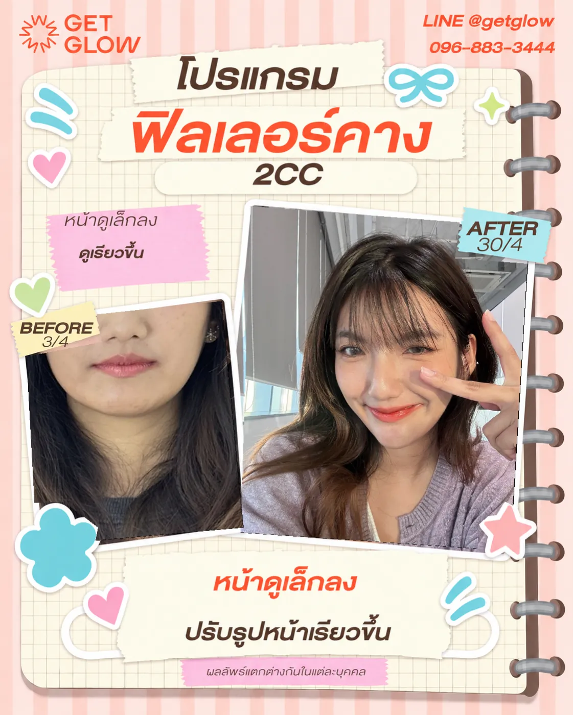 รีวิวจริง ฟิลเลอร์ — คาง ที่ GETGLOW Clinic สยามสแควร์วัน