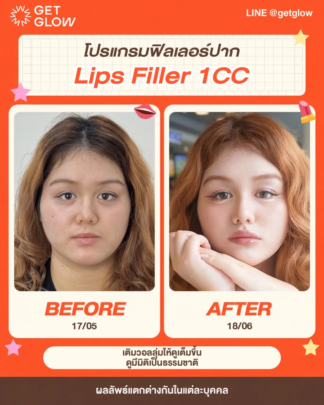 รีวิวจริง ฟิลเลอร์ — ริมฝีปาก ที่ GETGLOW Clinic สยามสแควร์วัน