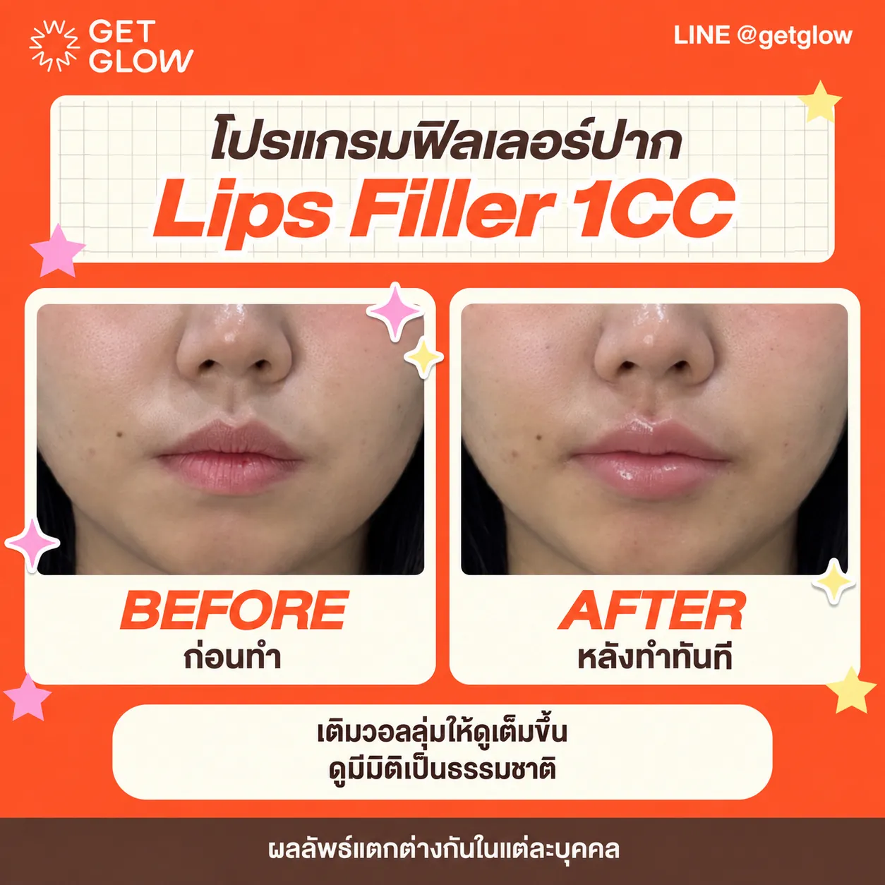 รีวิวจริง ฟิลเลอร์ — ริมฝีปาก ที่ GETGLOW Clinic สยามสแควร์วัน