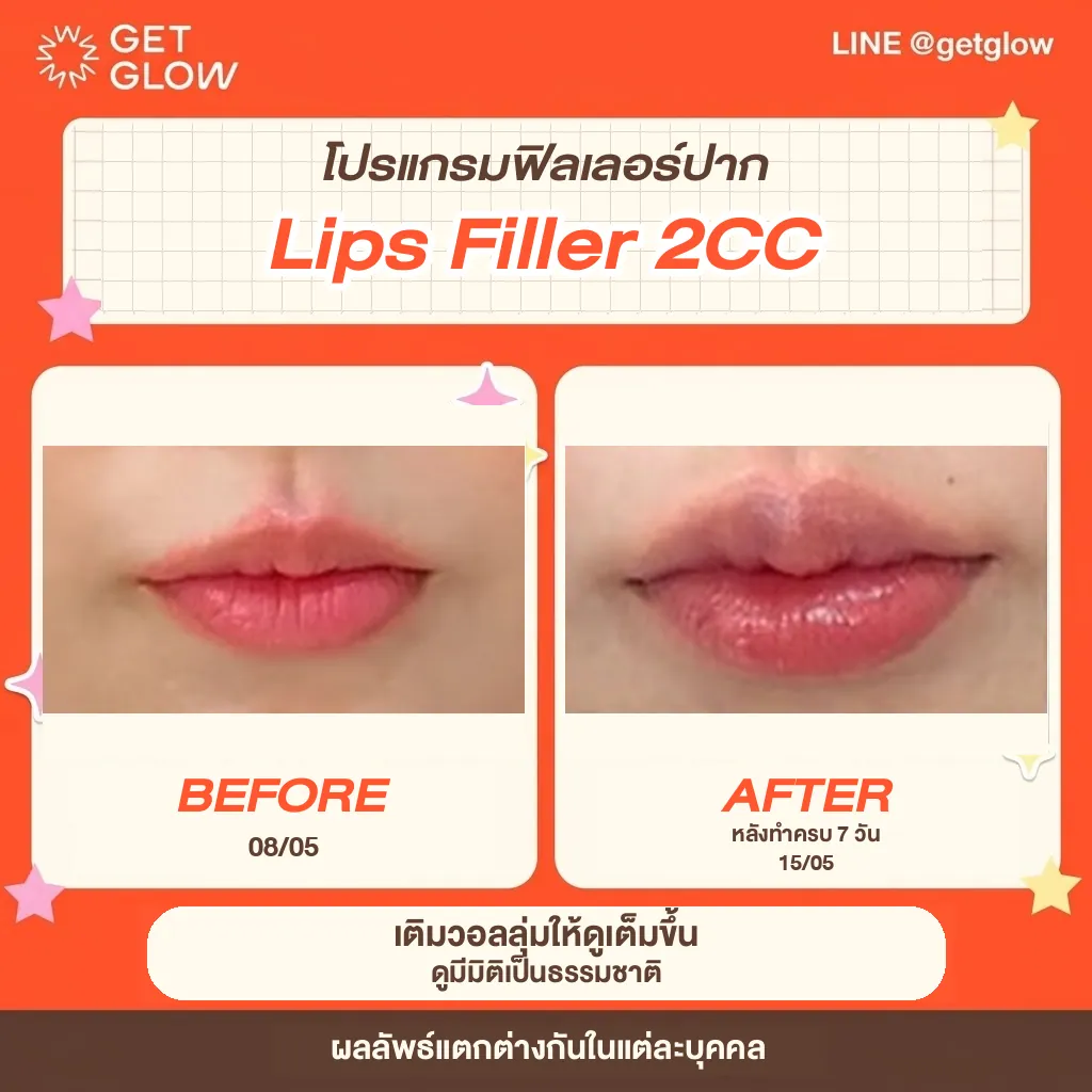 รีวิวจริง ฟิลเลอร์ — ริมฝีปาก ที่ GETGLOW Clinic สยามสแควร์วัน