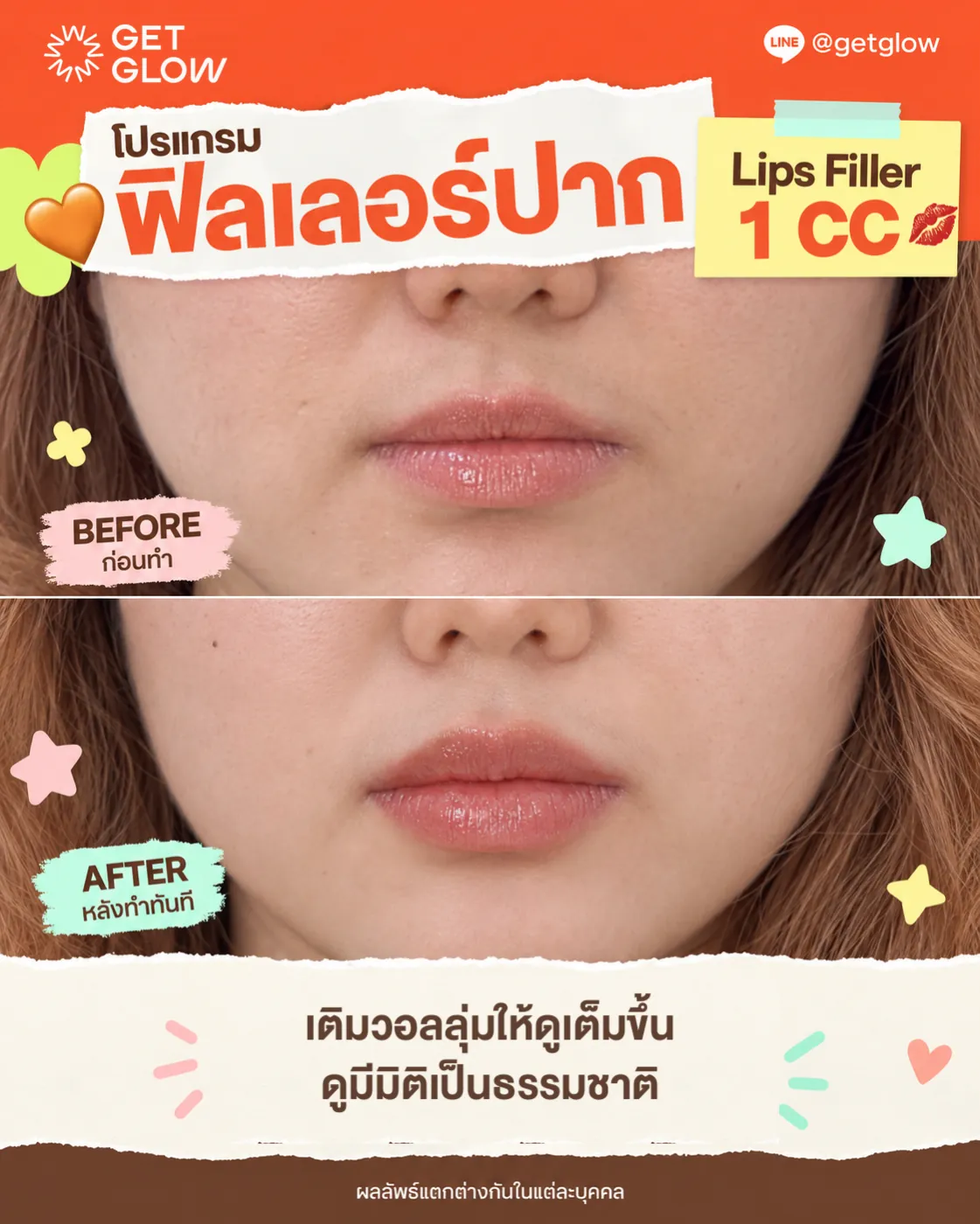 รีวิวจริง ฟิลเลอร์ — ริมฝีปาก ที่ GETGLOW Clinic สยามสแควร์วัน