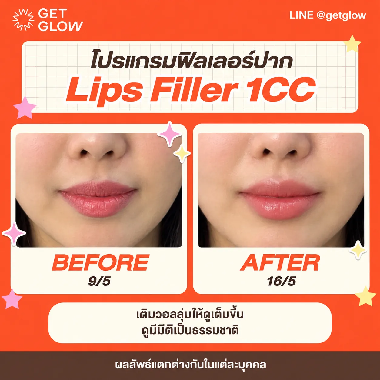 รีวิวจริง ฟิลเลอร์ — ริมฝีปาก ที่ GETGLOW Clinic สยามสแควร์วัน