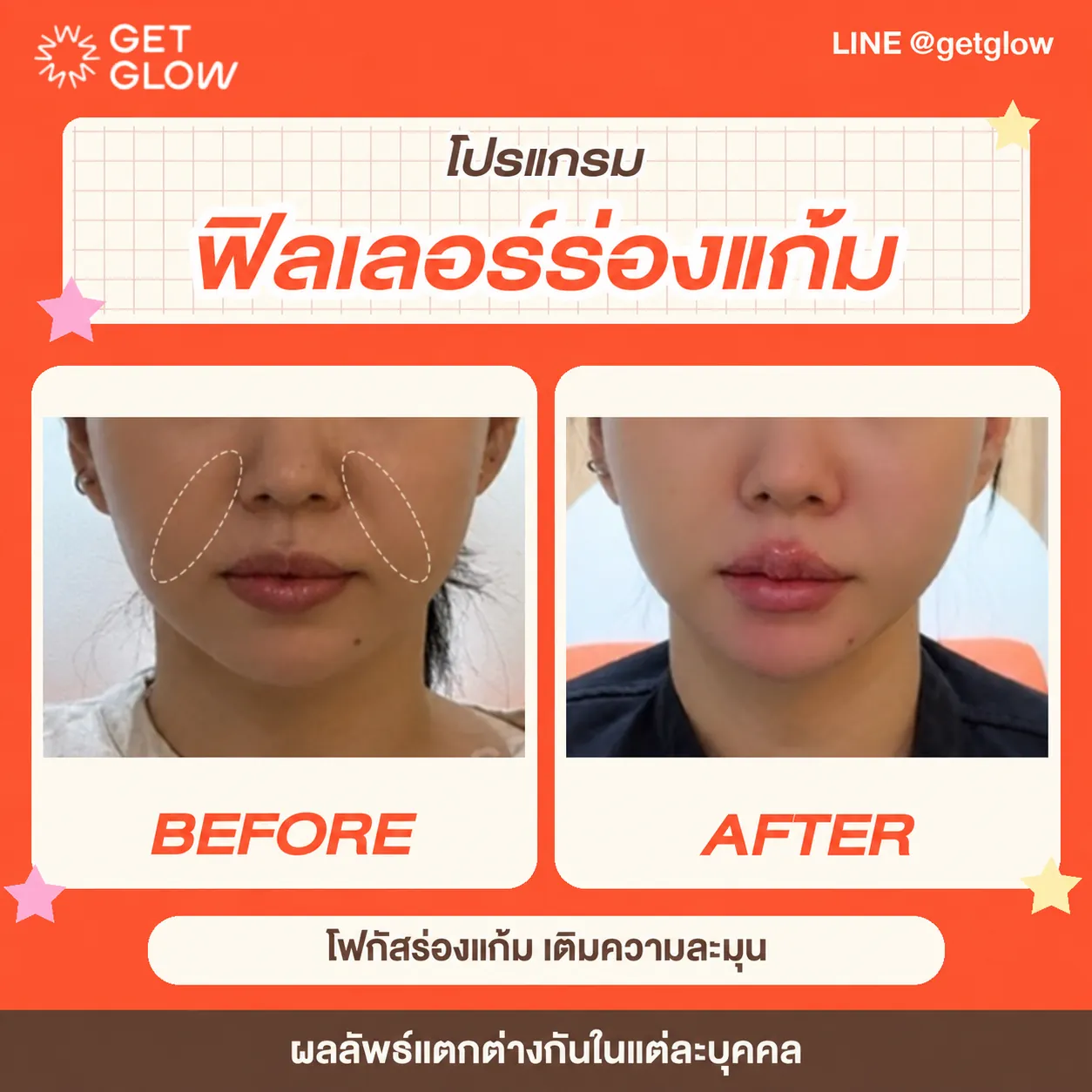 รีวิวจริง ฟิลเลอร์ — ร่องแก้ม ที่ GETGLOW Clinic สยามสแควร์วัน