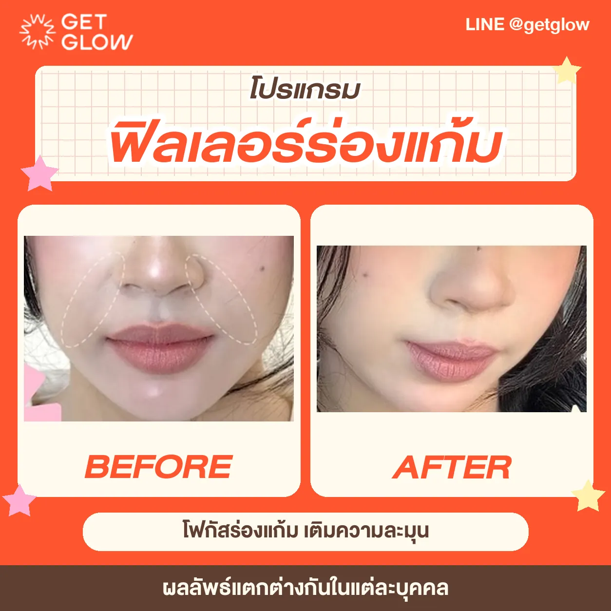 รีวิวจริง ฟิลเลอร์ — ร่องแก้ม ที่ GETGLOW Clinic สยามสแควร์วัน