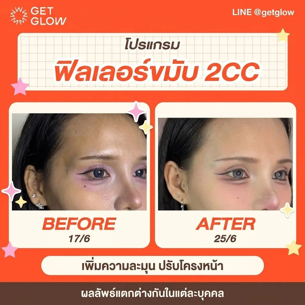 รีวิวจริง ฟิลเลอร์ — ขมับ ที่ GETGLOW Clinic สยามสแควร์วัน