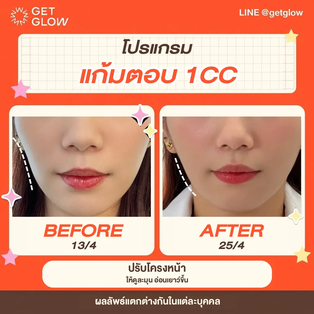 รีวิวจริง ฟิลเลอร์ — ขมับ ที่ GETGLOW Clinic สยามสแควร์วัน