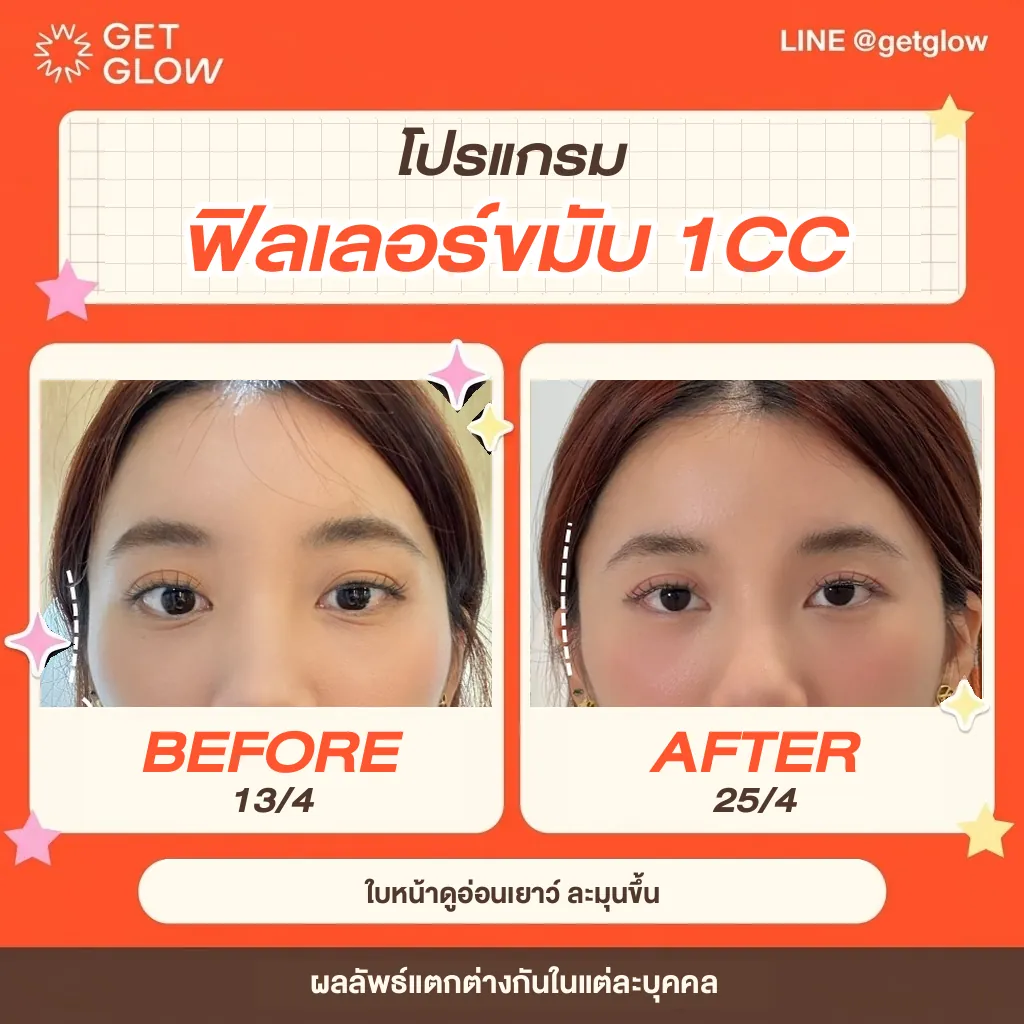 รีวิวจริง ฟิลเลอร์ — ขมับ ที่ GETGLOW Clinic สยามสแควร์วัน
