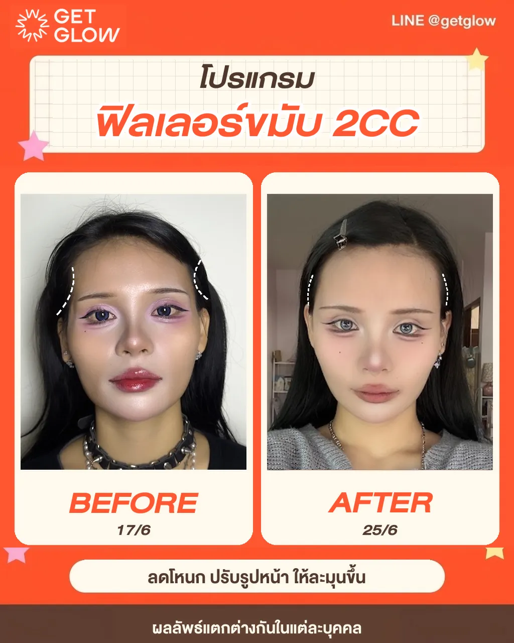 รีวิวจริง ฟิลเลอร์ — ขมับ ที่ GETGLOW Clinic สยามสแควร์วัน