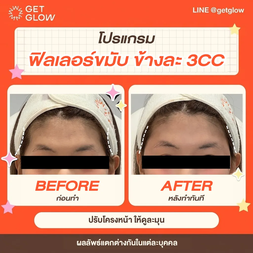 รีวิวจริง ฟิลเลอร์ — ขมับ ที่ GETGLOW Clinic สยามสแควร์วัน
