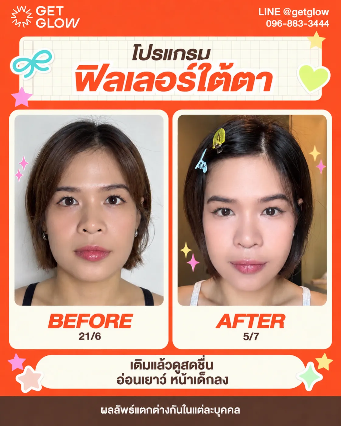 รีวิวจริง ฟิลเลอร์ — ใต้ตา ที่ GETGLOW Clinic สยามสแควร์วัน