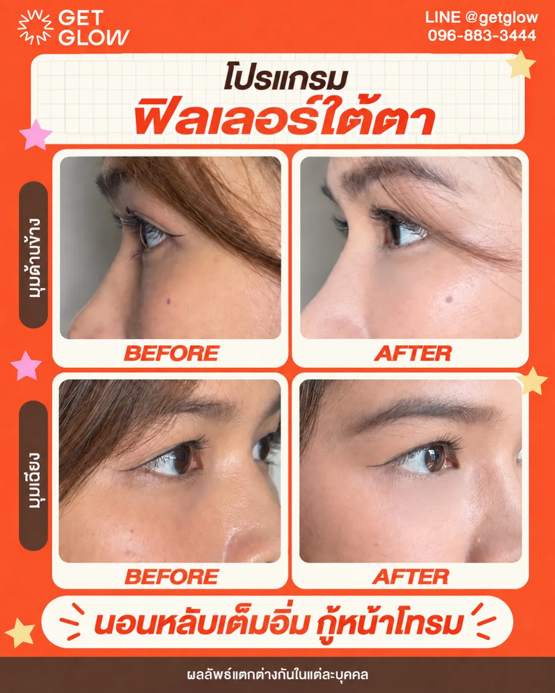 รีวิวจริง ฟิลเลอร์ — ใต้ตา ที่ GETGLOW Clinic สยามสแควร์วัน