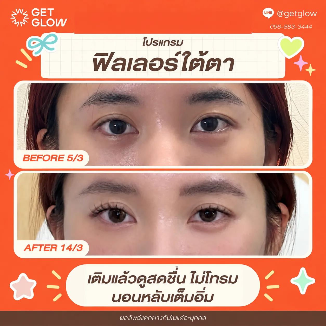รีวิวจริง ฟิลเลอร์ — ใต้ตา ที่ GETGLOW Clinic สยามสแควร์วัน