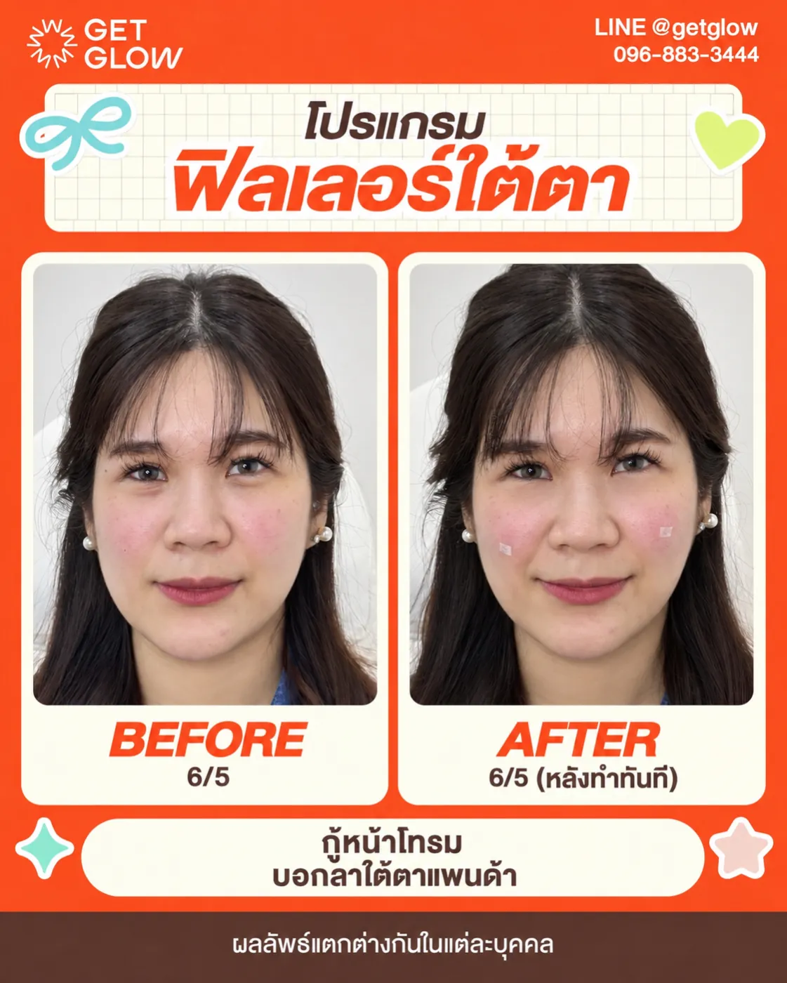 รีวิวจริง ฟิลเลอร์ — ใต้ตา ที่ GETGLOW Clinic สยามสแควร์วัน