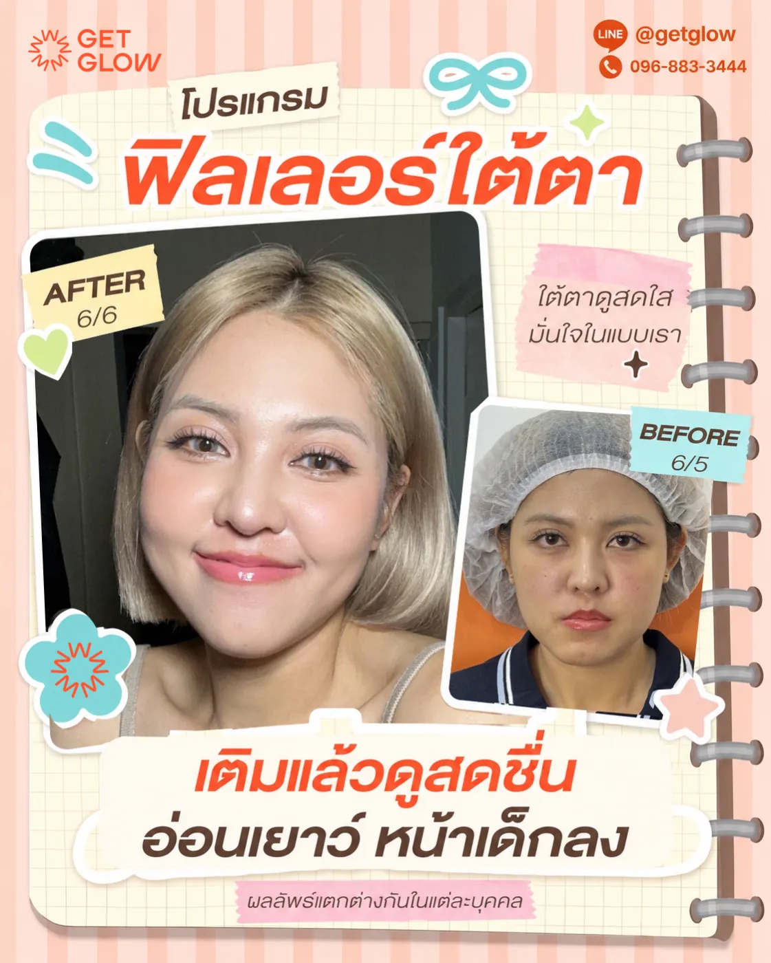 รีวิวจริง ฟิลเลอร์ — ใต้ตา ที่ GETGLOW Clinic สยามสแควร์วัน
