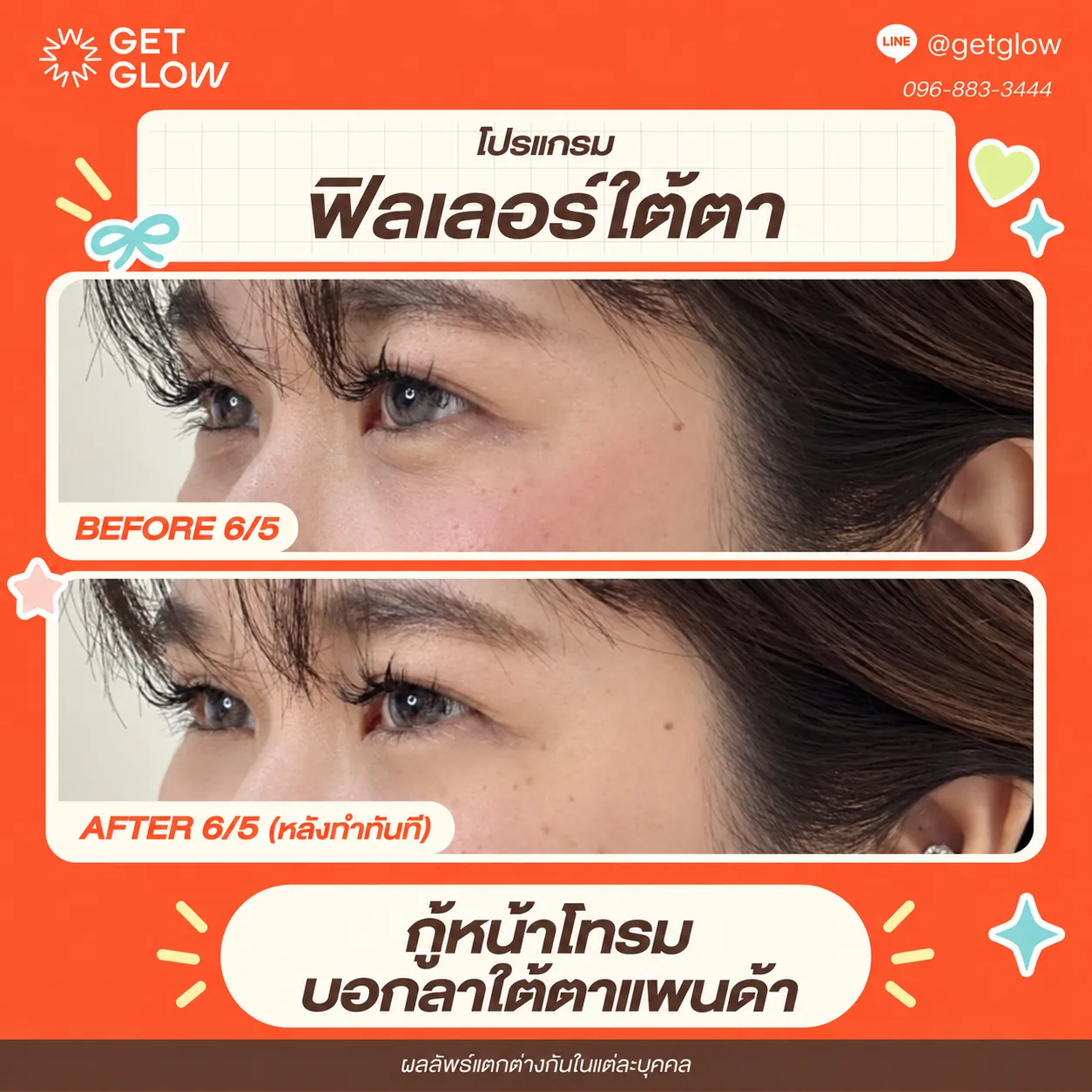 รีวิวจริง ฟิลเลอร์ — ใต้ตา ที่ GETGLOW Clinic สยามสแควร์วัน