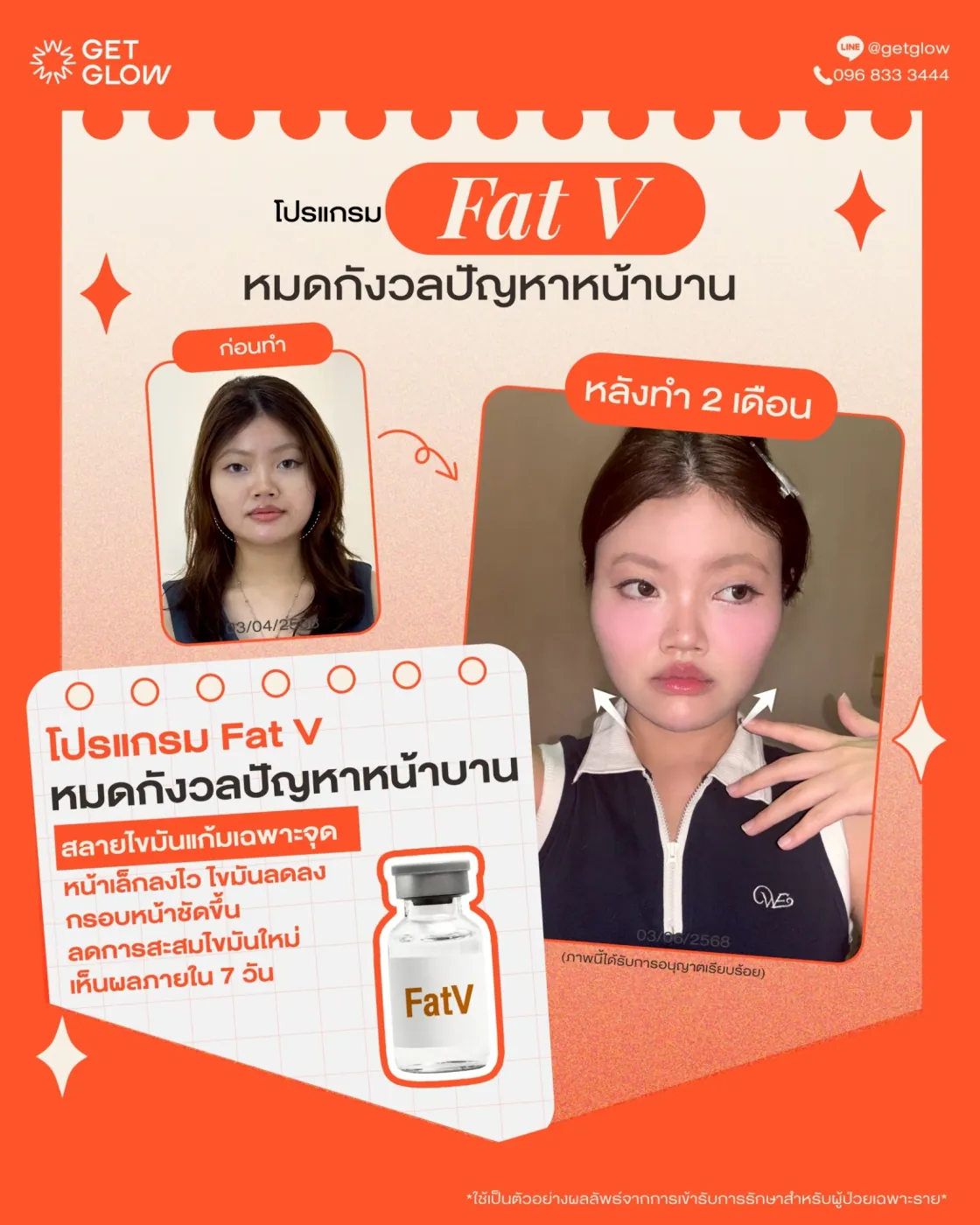 รีวิวจริง ดูแลรูปร่าง — Inmode Mini FX ที่ GETGLOW Clinic สยามสแควร์วัน