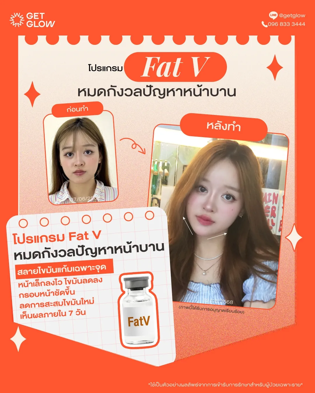 รีวิวจริง ดูแลรูปร่าง — Inmode Mini FX ที่ GETGLOW Clinic สยามสแควร์วัน