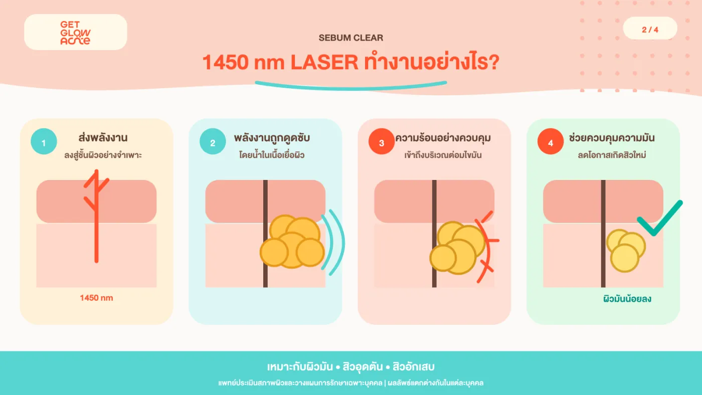 1450 nm Laser ทำงานอย่างไร — ส่งพลังงานลงสู่ชั้นผิวอย่างจำเพาะ พลังงานถูกดูดซับโดยน้ำในเนื้อเยื่อผิว เกิดความร้อนอย่างควบคุมบริเวณต่อมไขมัน ช่วยควบคุมความมันและลดโอกาสเกิดสิวใหม่