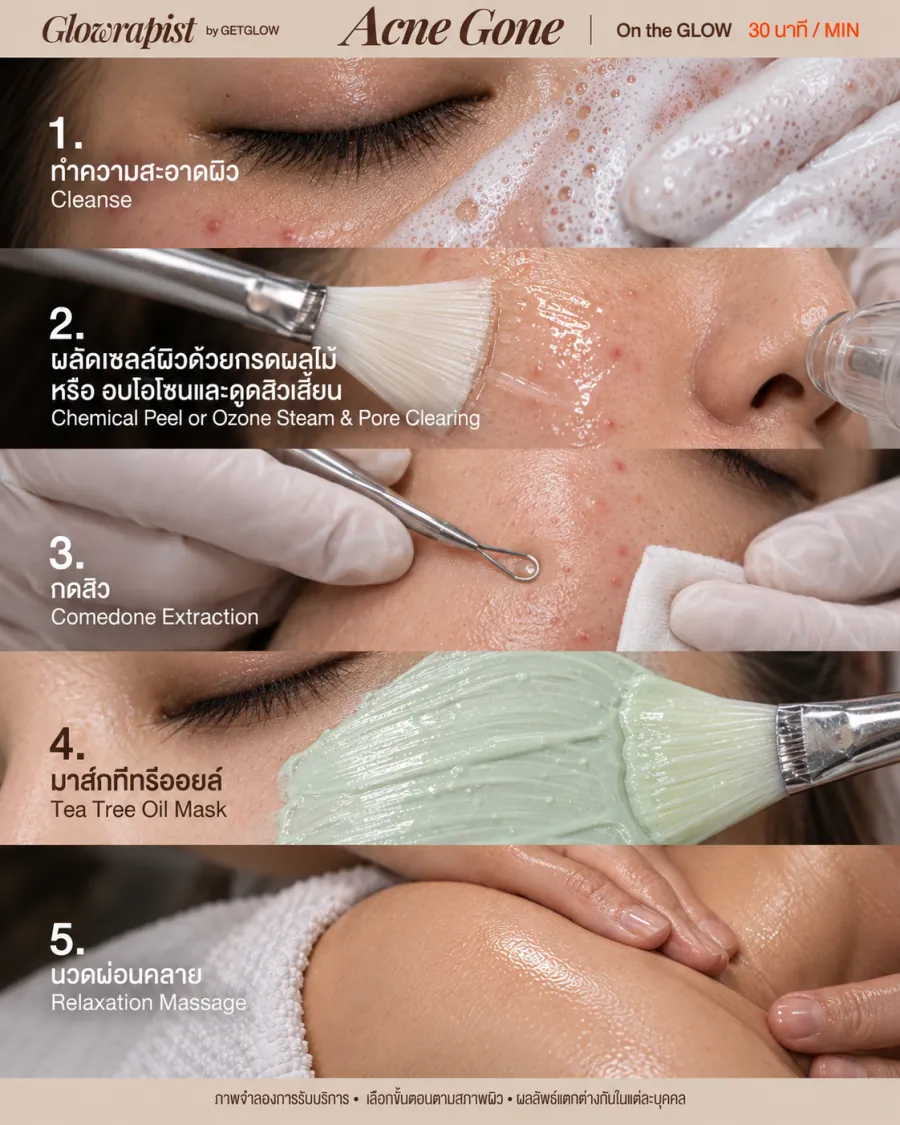 ขั้นตอนทรีตเมนต์ GLOWRAPIST สูตร Acne Gone แบบ On the GLOW 30 นาที — ทำความสะอาดผิว, ผลัดเซลล์ผิวด้วยกรดผลไม้หรืออบโอโซนและดูดสิวเสี้ยน, กดสิว, มาส์กทีทรีออยล์, นวดผ่อนคลาย